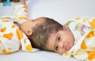 نجاح فصل التوأم الملتصق الإريتري 